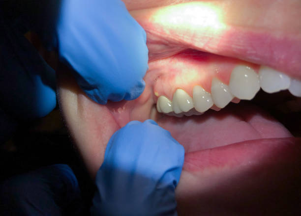 Best Emergency Care for Gum Disease in Westchester, FL